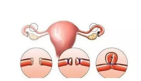 二代人工受孕费用